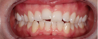 Invisalign®