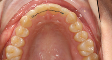 Invisalign lite