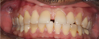 Invisalign®