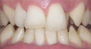 Crossbite