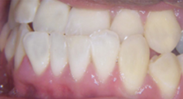 Jaw Surgery