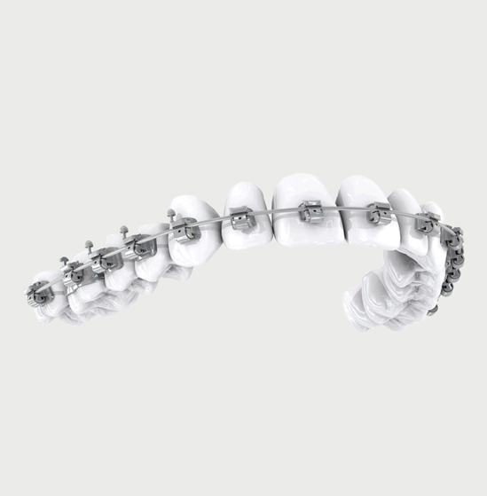 Types of Braces