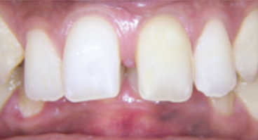 Overbite