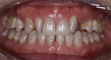 Teeth requiring white build up