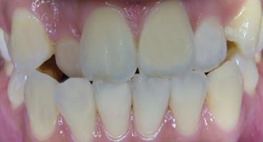 Underbite