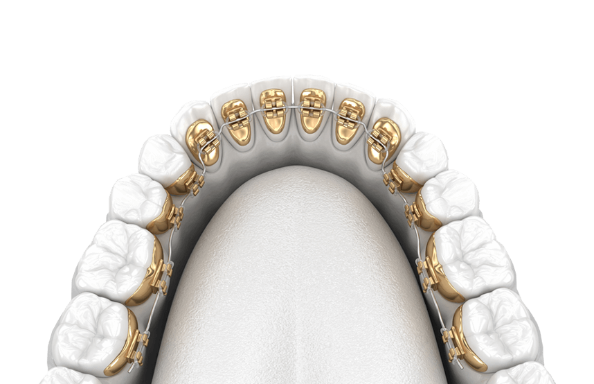 Lingual braces