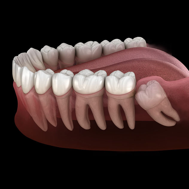 Why do wisdom teeth
need to be removed? Why do wisdom teeth
need to be removed?