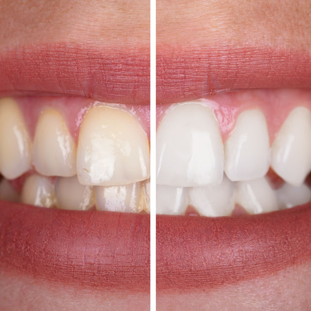 Why are my
teeth discoloured? Why are my
teeth discoloured?