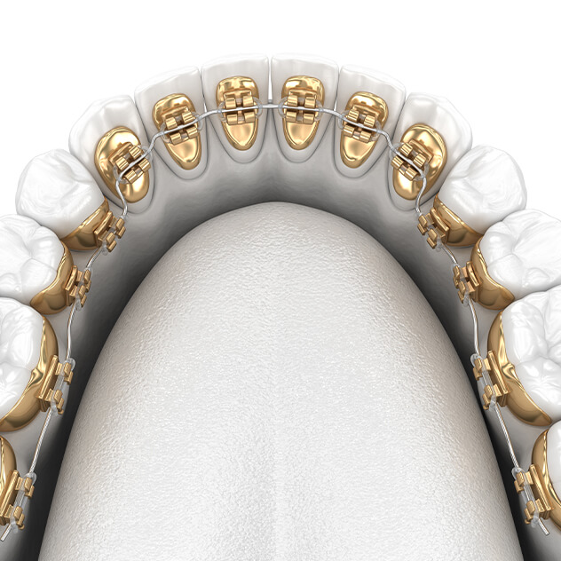 Lingual braces Lingual braces