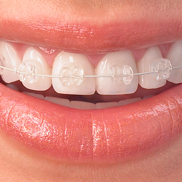 Ceramic braces Ceramic braces