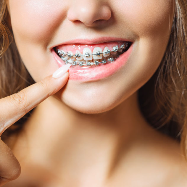 Fixed metal braces Fixed metal braces